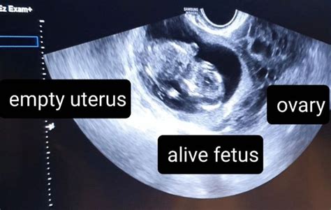 best test for ovarian torsion|ovarian torsion vs ectopic pregnancy.